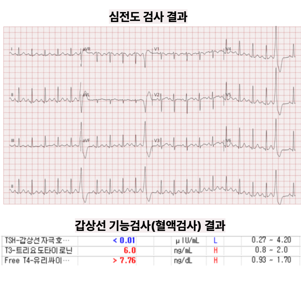 20대 여성의 두근거림·어지럼 — ‘갑상선기능항진증’과 연관된 빈맥·부정맥