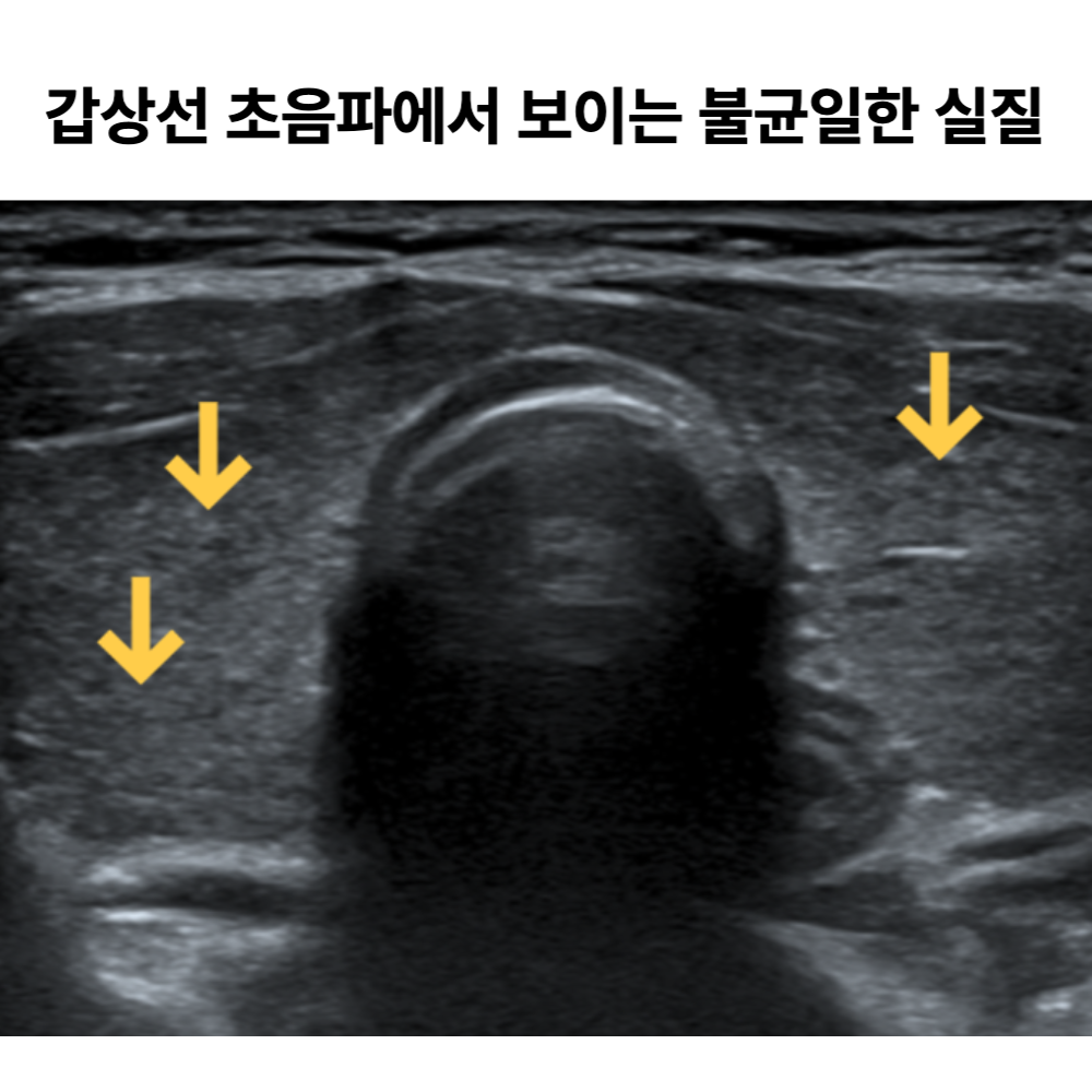 갑상선 초음파 검사 결과: 불균일한 갑상선 실질 소견