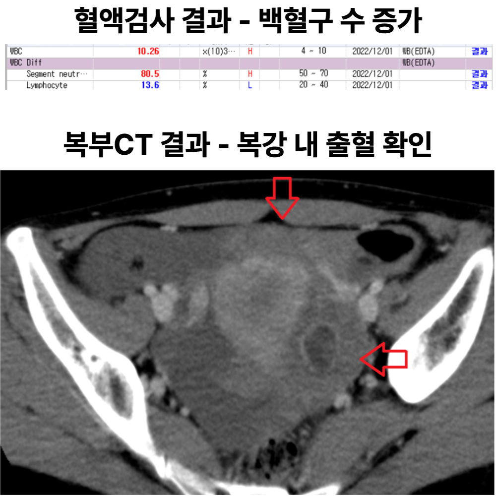 급성 아랫배 통증 — 복강내출혈 동반 ‘황체낭종 파열’