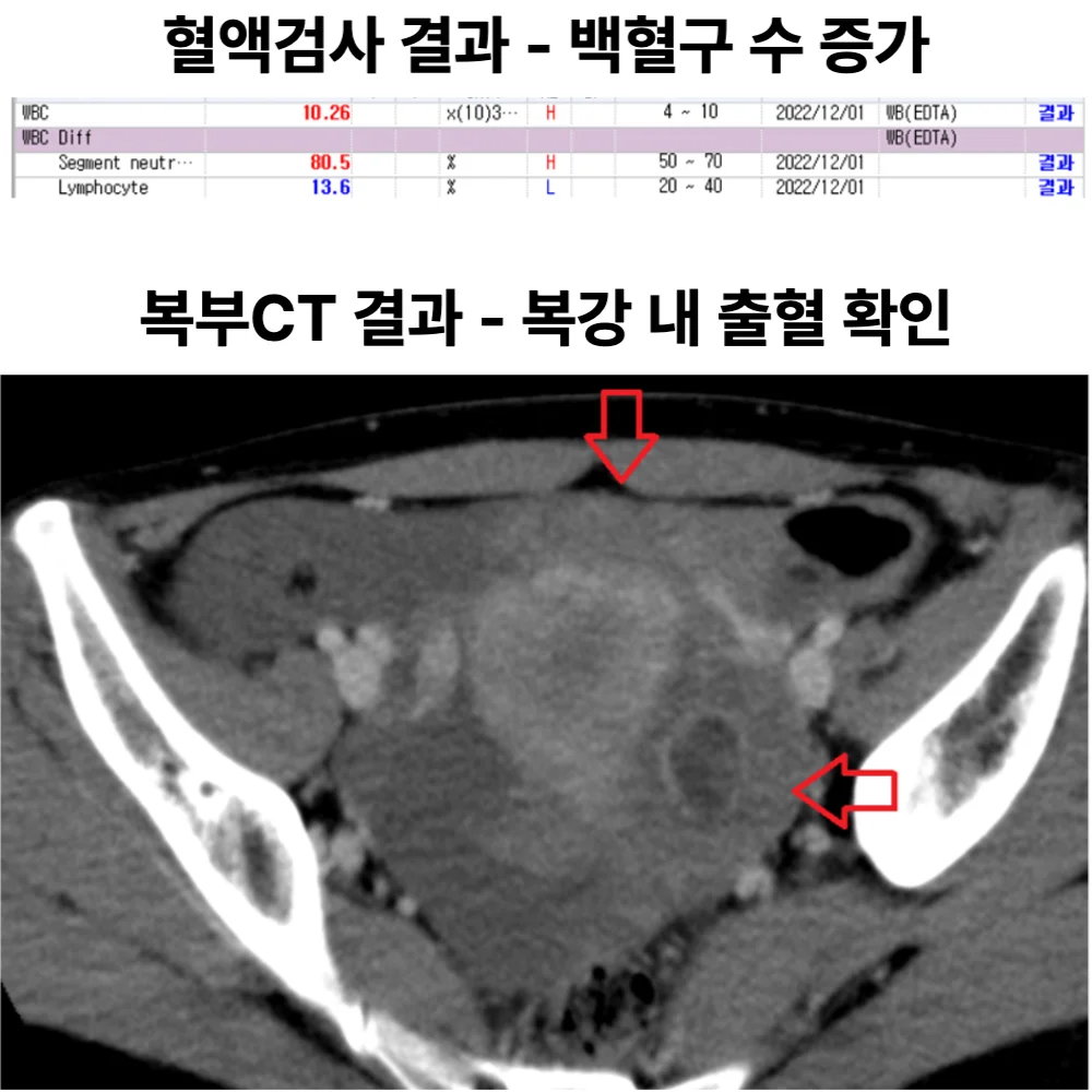 급성 아랫배 통증 — 복강내출혈 동반 ‘황체낭종 파열’