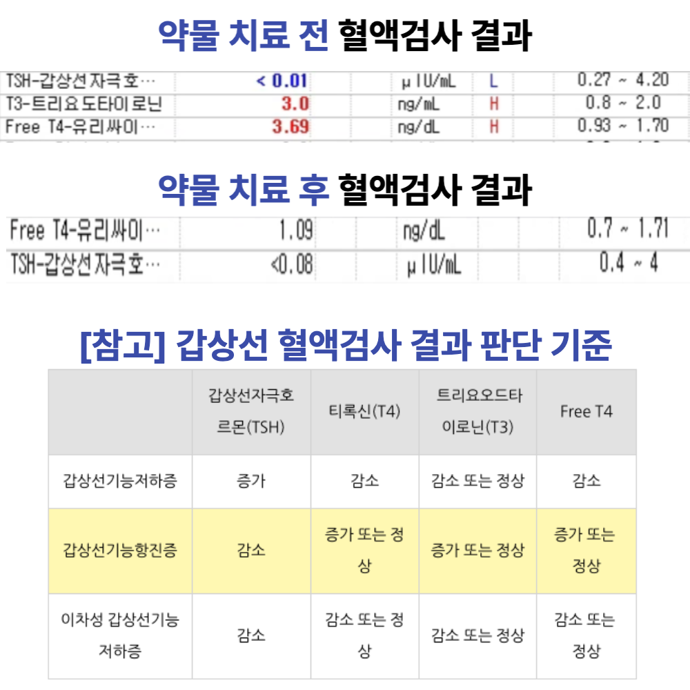 두근거림·식은땀·피로 — TSI 6.57, TSH <0.01로 확인된 ‘그레이브스병(갑상선기능항진증)’
