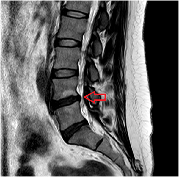 MRI: 허리디스크 발견