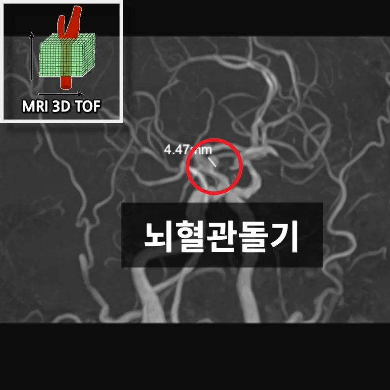 뇌혈관의 돌출 부위를 붉은 원과 4.47밀리미터 표기로 표시한 뇌 MRA 영상