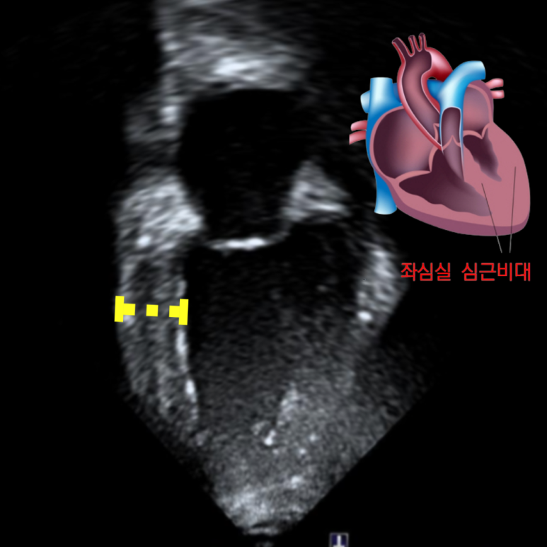 기침이 멈추지 않고 혈압이 매우 높았던 30대 — 좌심실 기능 저하로 확인된 심부전