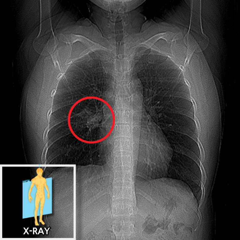 X-ray 검사 결과