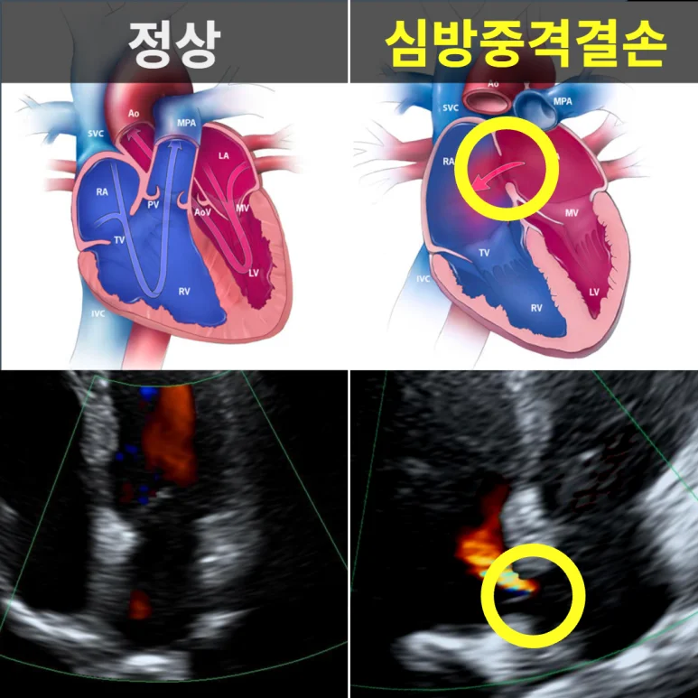 정상 심장과 심방중격결손이 있는 심장의 해부 단면·심초음파 비교
