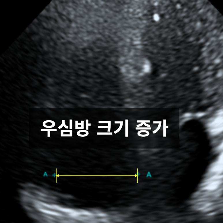 우심방 비대