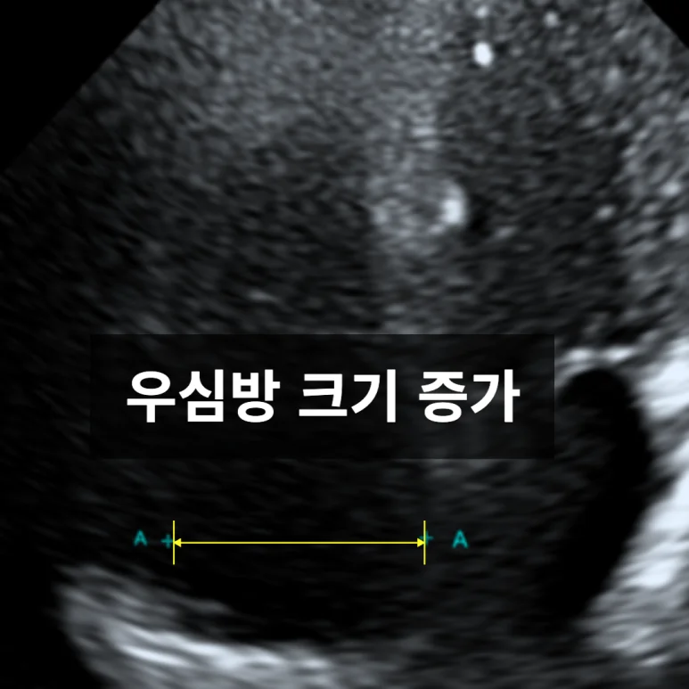 우심방 비대