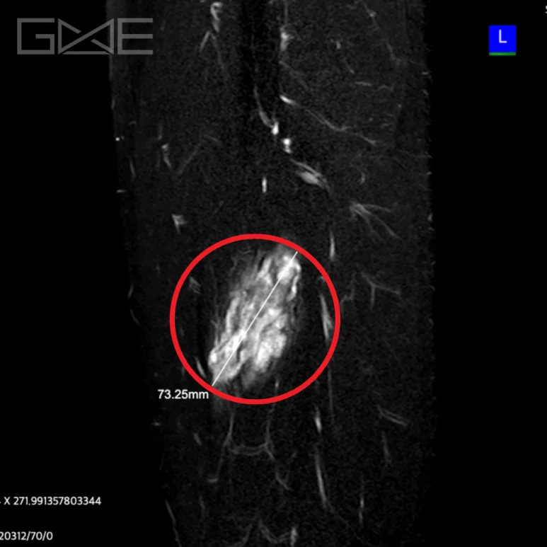 MRI