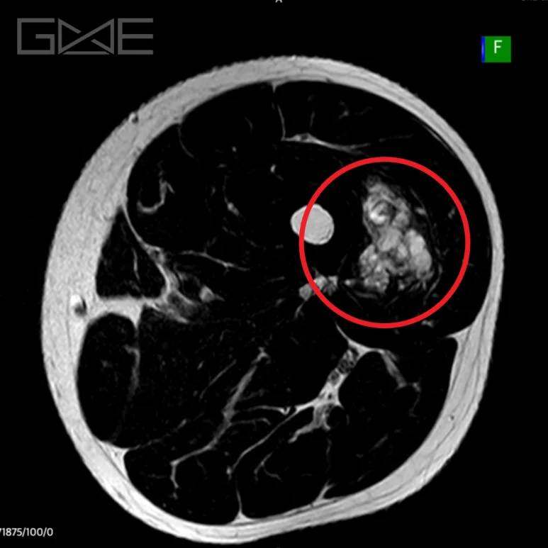 MRI
