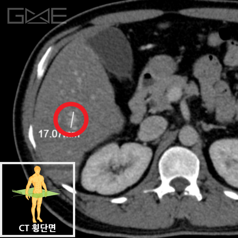 간CT 횡단면