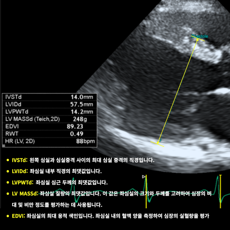심초음파: 좌심실비대/확장