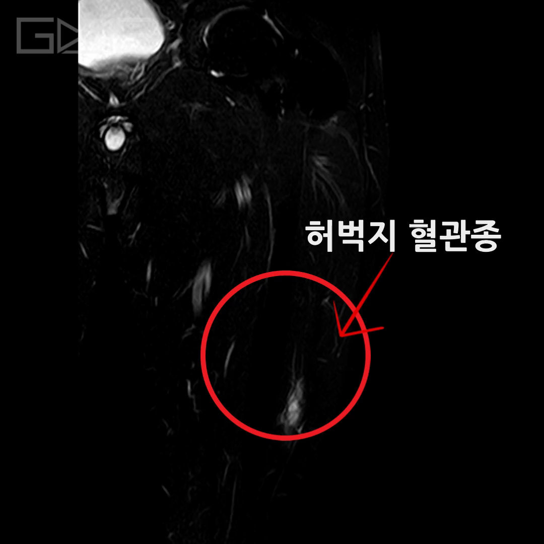 허벅지 통증, 단순 근육통일까? MRI에서 확인된 혈관성 병변