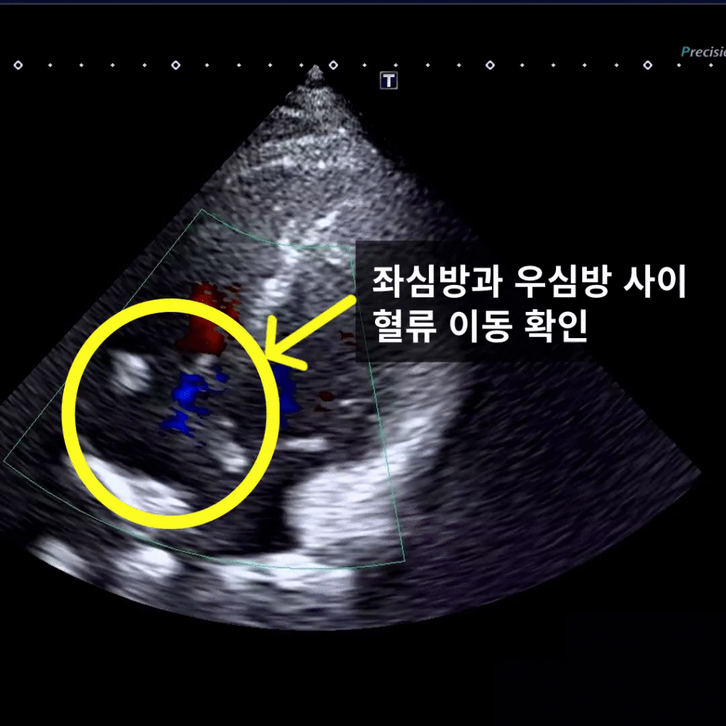 좌심방과 우심방사이 비정상적인 혈류 이동