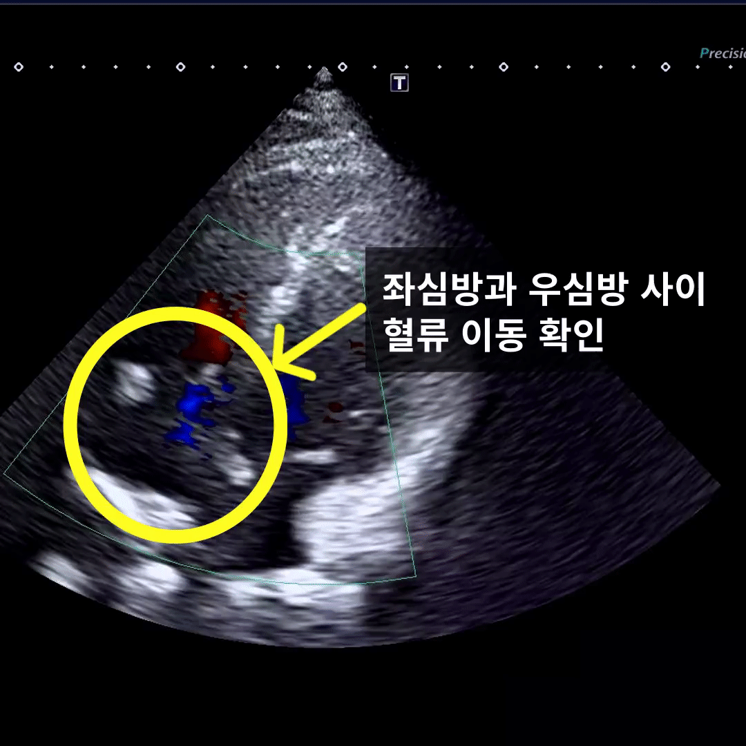 심비대와 관련된 심장 구조 변화를 설명하는 이미지