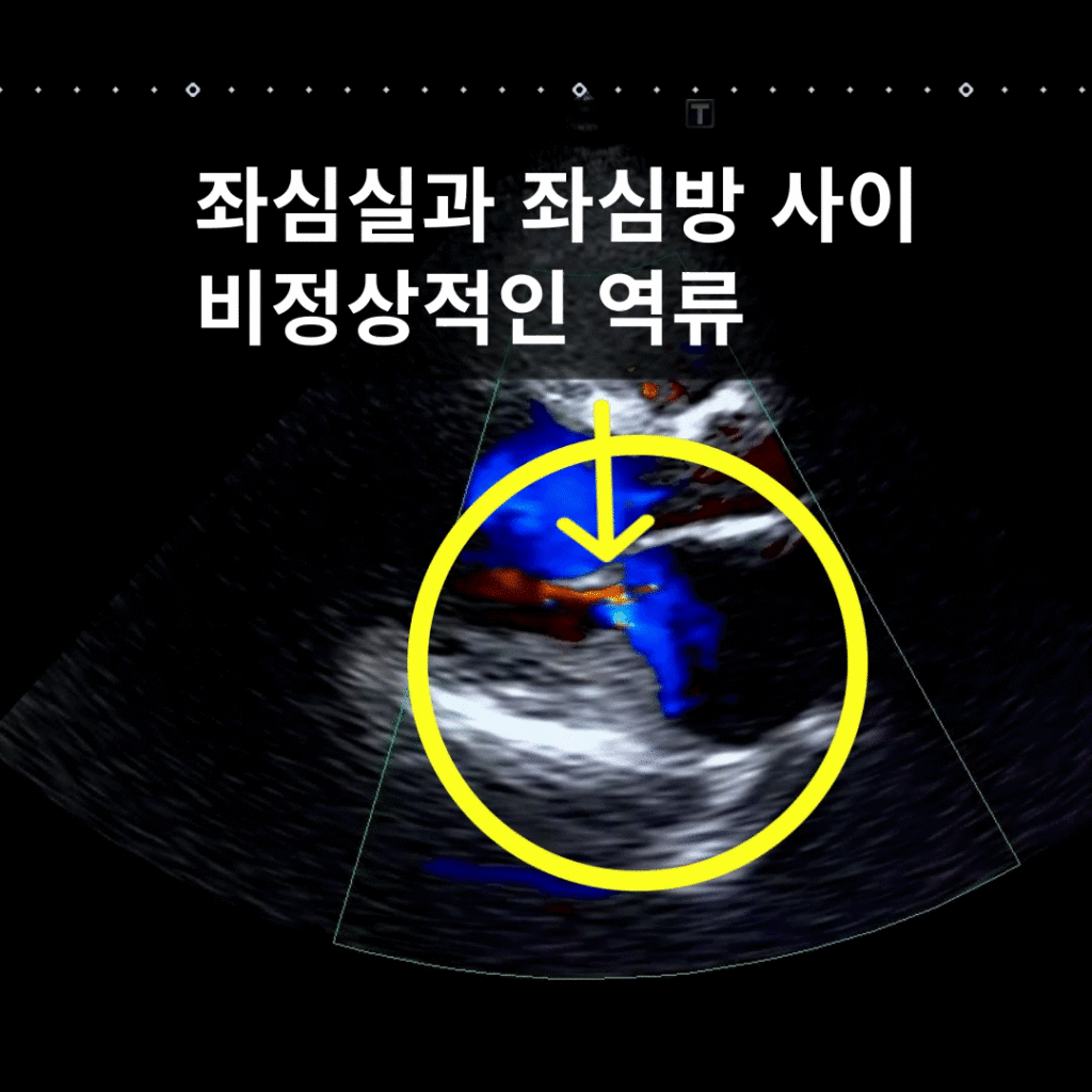 어지럼·피로·부종 — EF 20–30%, 좌심실비대·확장과 대동맥판 역류로 확인된 심부전