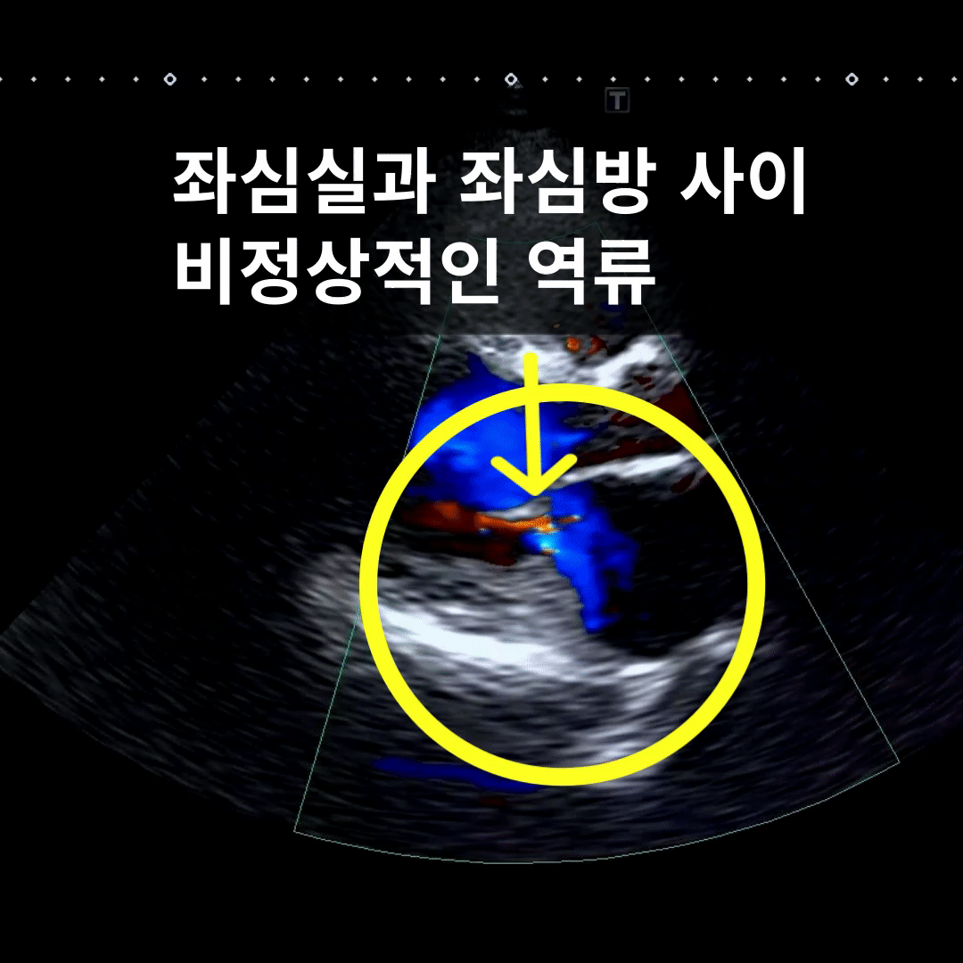 어지럼·피로·부종 — EF 20–30%, 좌심실비대·확장과 대동맥판 역류로 확인된 심부전