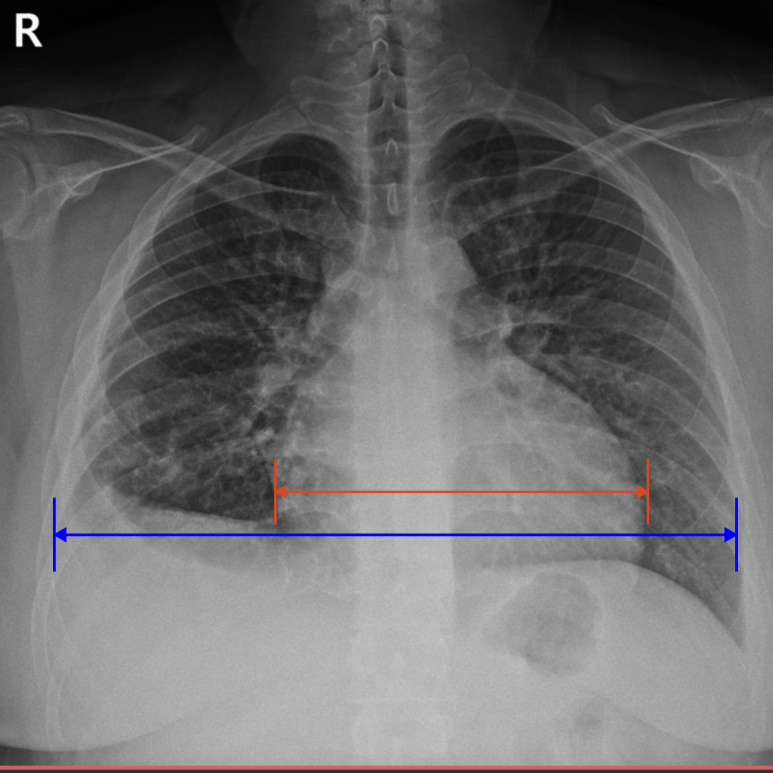 X-RAY 검사에 확인된 심장비대