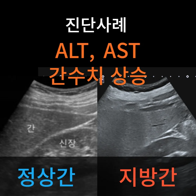기존 지방간 사례에 등록된 간초음파 비교 영상입니다.