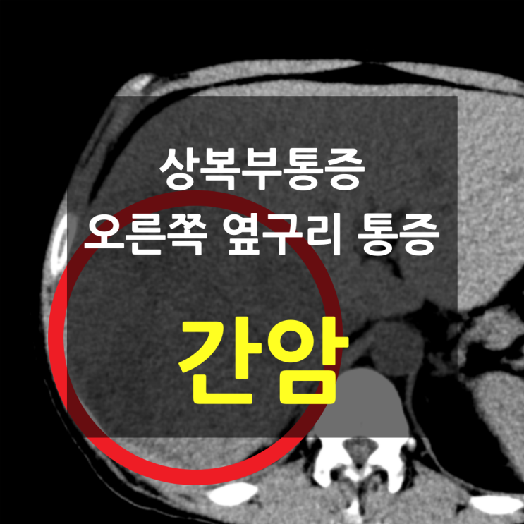 상복부 통증, 오른쪽 옆구리 통증 — 간암 진단