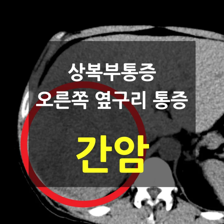 상복부 통증, 오른쪽 옆구리 통증 — 간암 진단