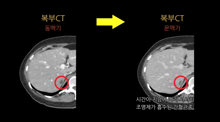 복부CT(동맥기): 간 우엽 9cm 크기 종괴
