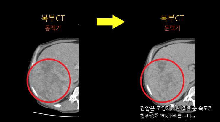 복부CT(문맥기): 조영제 흡수 확인