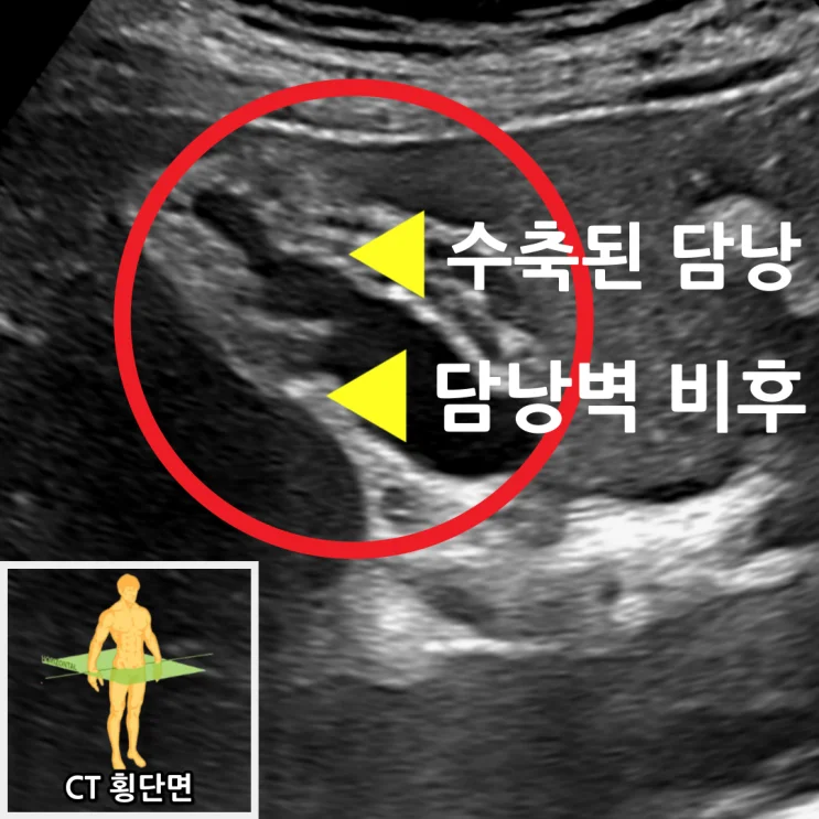 복부 초음파에서 담낭 이상 발견 — 담낭염 진단