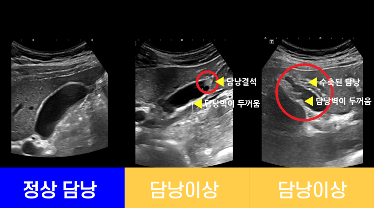 복부CT: 담낭 이상 확인