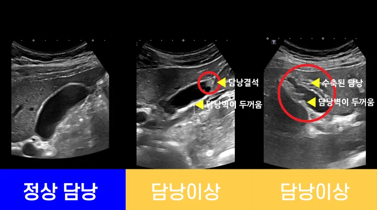 복부CT: 담낭 이상 확인