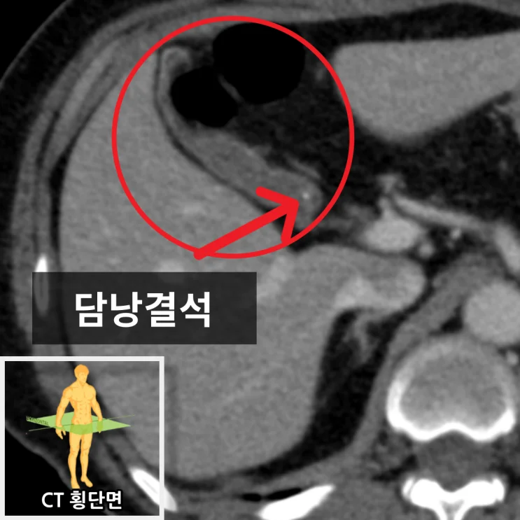 담낭결석