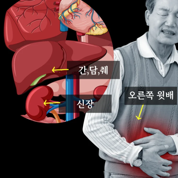 담낭결석, 오른쪽 윗배 통증 — 담낭염 진단