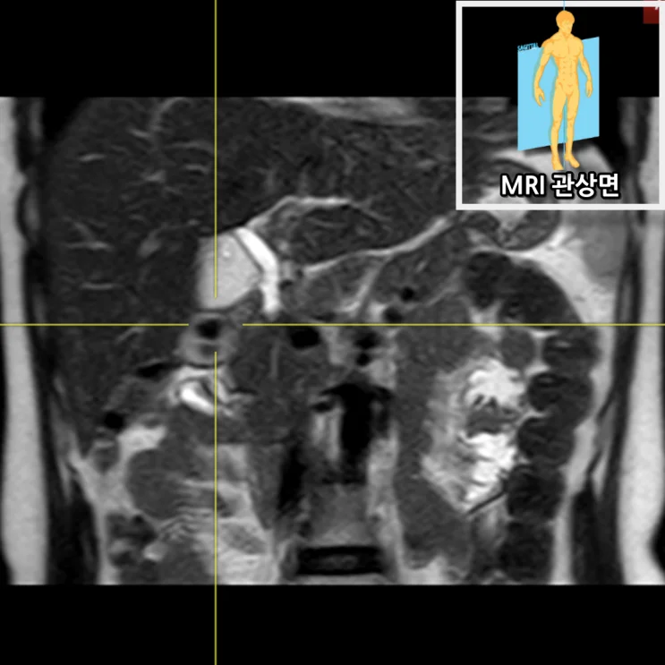 복부 MRI T1 영상 - 담낭 내 결석 및 담낭벽 비후 관찰