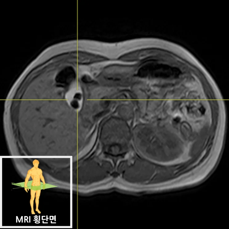 복부 MRI T2 영상 - 담낭 질환 참고 해부도