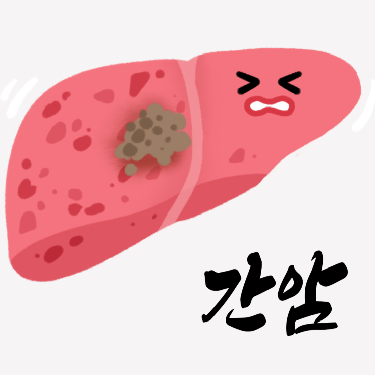 복부 MRI T1 영상 - 간 좌엽 종양 확인