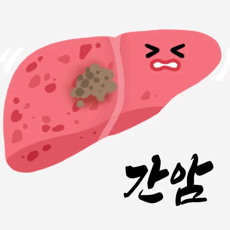 복부 MRI T1 영상 - 간 좌엽 종양 확인