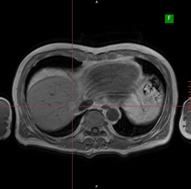 복부 MRI T2 영상 - 조영 후 간 종양 경계 뚜렷함