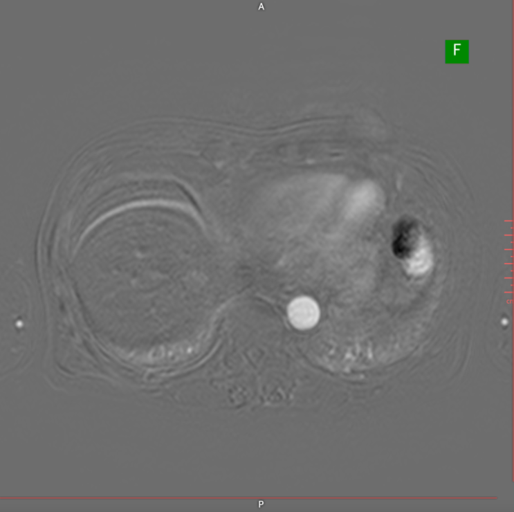 간암 초기 증상 무증상 — 건강검진에서 발견