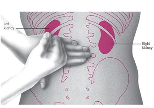 복부CT: 좌측 요로 결석 소견