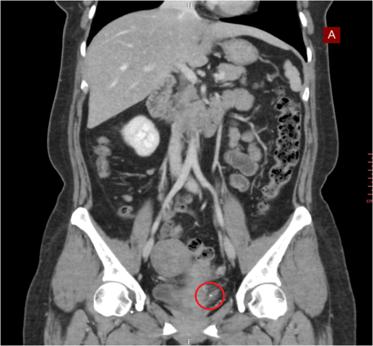 소변검사 결과: 혈뇨 +++