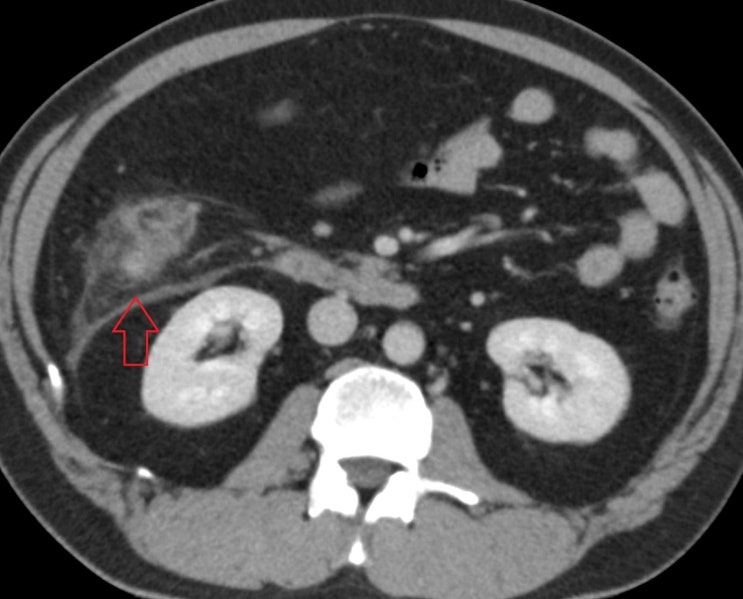 복부CT: 대장 게실 주변 염증 소견