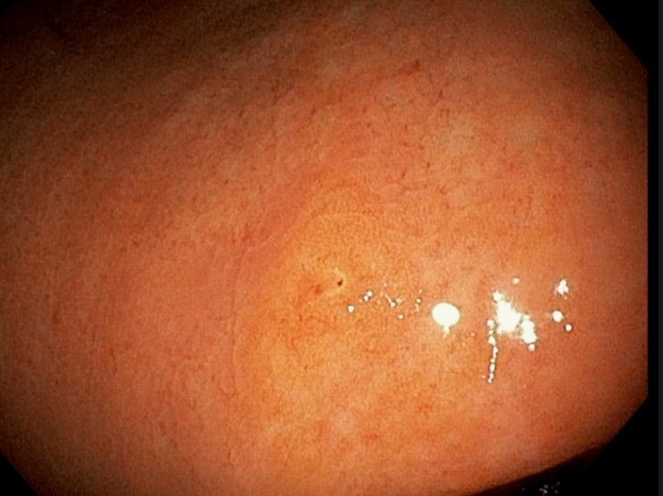 위내시경: 단독 융기된 미란성 위염