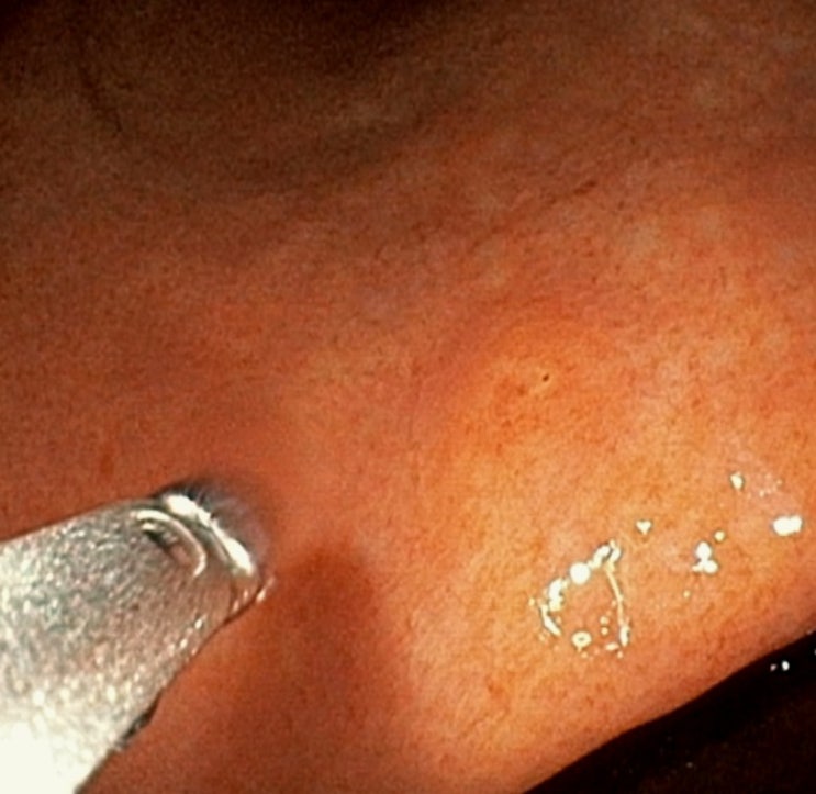 위내시경: 조직검사 부위