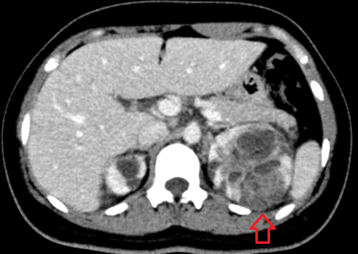 왼쪽 아랫배 통증·메스꺼움 — 복부CT에서 확인된 급성 신우신염 #좌하복부통증