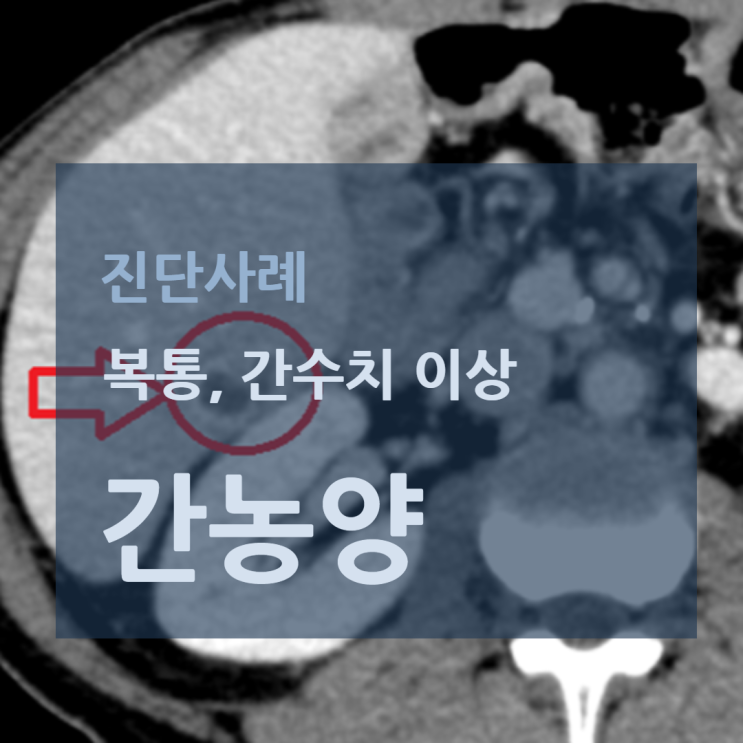 복부CT: 간에서 병변이 보이는 소견