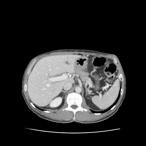 복부CT: 간 6번 구획 간농양 표시(빨간 동그라미)