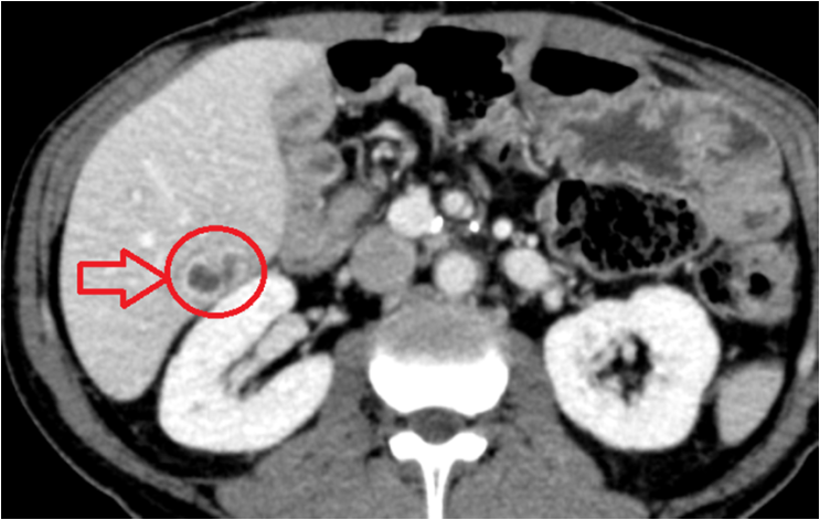 우상복부 통증, 간수치이상 — 간농양 진단