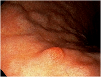 위내시경: 조직 채취 시행