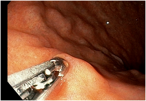 신경내분비종양(NET) 발생 부위 참고자료