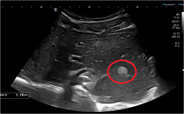 무증상, 건강검진 — 간선종 발견 #간암 우려